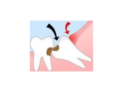 吃完飯后老塞牙？別大意！這可能是你的牙齒在報警