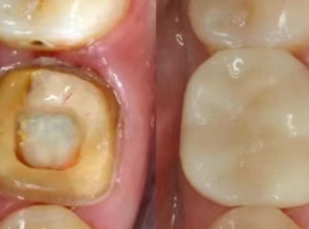 根管治療（抽神經(jīng)）后，為什么一定要做牙冠？