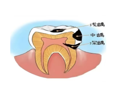 乳牙不是 “過(guò)渡品”——保護(hù)孩子牙齒從第一顆開(kāi)始