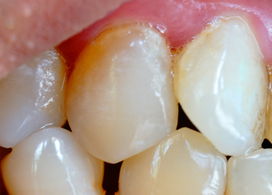 牙齒表面的牙釉質(zhì)掉了還可以修復(fù)嗎？