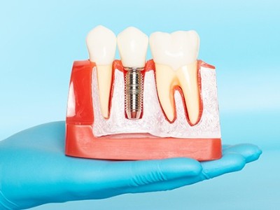 種牙VS鑲牙，你適合哪種?