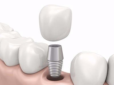 在承德哪家口腔醫(yī)院口腔種植齒好一點，惟德口腔醫(yī)院值得您的選擇