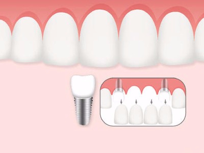 惟德口腔口腔種植怎么樣？惟德口腔就來為您一一解答